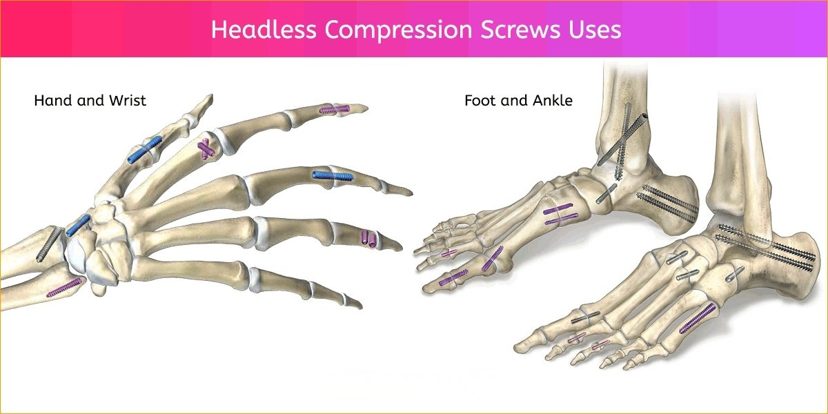 Headless Compression Screws – Bright Ortho